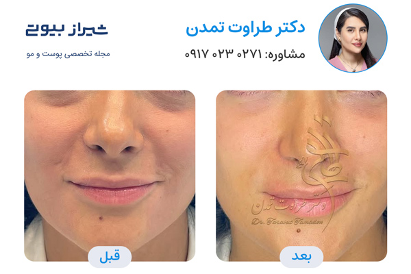 جوانسازی پوست در شیراز - دکتر طراوت تمدن