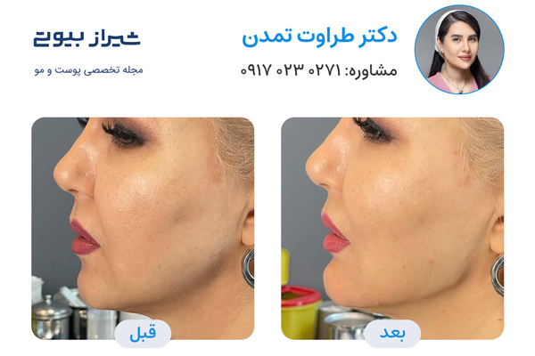 جوانسازی پوست در شیراز - دکتر طراوت تمدن