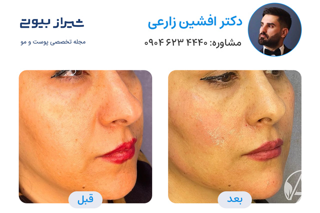 تصاویر قبل و بعد جوانسازی پوست در شیراز دکتر افشین زارعی