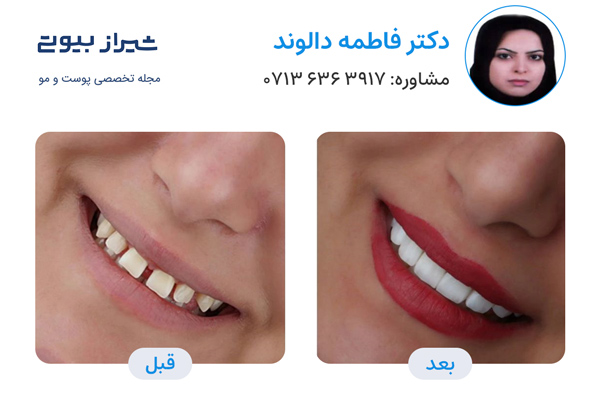 10 بهترین دکتر کامپوزیت دندان در شیراز، دکتر فاطمه دالوند