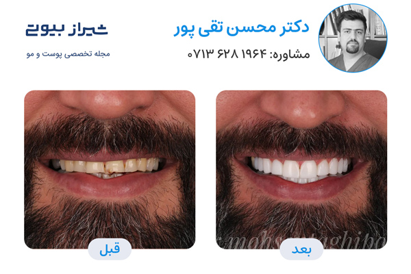 10 بهترین دکتر کامپوزیت دندان در شیراز، دکتر محسن تقی پور