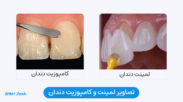 عکس لمینت و کامپوزیت دندان