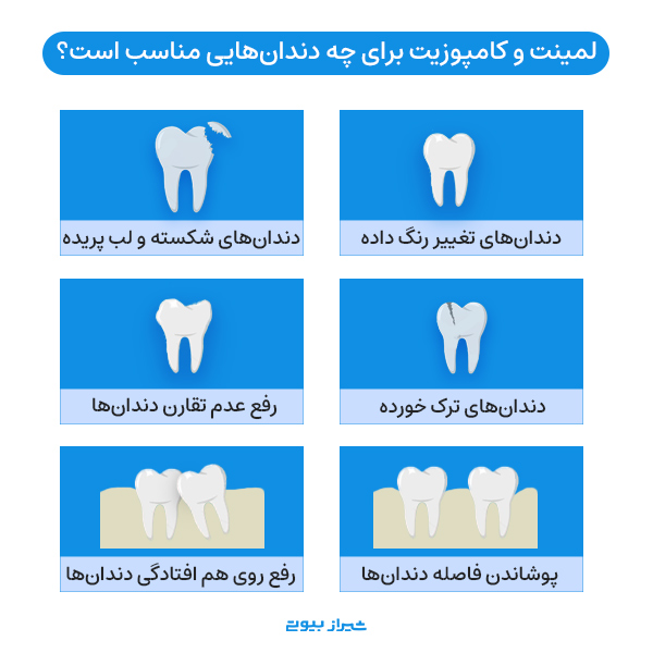 لمینت و کامپوزیت برای چه دندان هایی مناسب ست؟