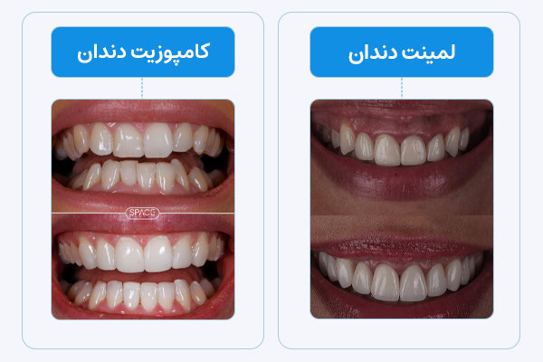 تفاوت های لمینت و کامپوزیت دندان - تصاویر