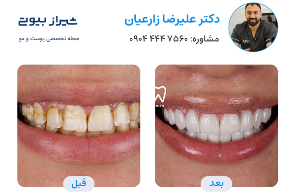 کامپوزیت دندان در شیراز - دکتر علیرضا زارعیان