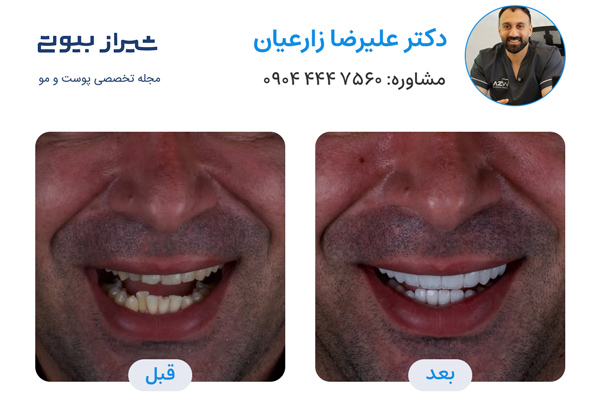 کامپوزیت دندان در شیراز - دکتر علیرضا زارعیان