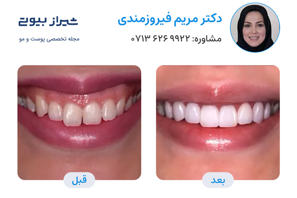 بهترین دکتر کامپوزیت دندان در شیراز، دکتر مریم فیروزمندی