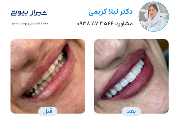 کامپوزیت دندان در شیراز - دکتر لیلا کریمی