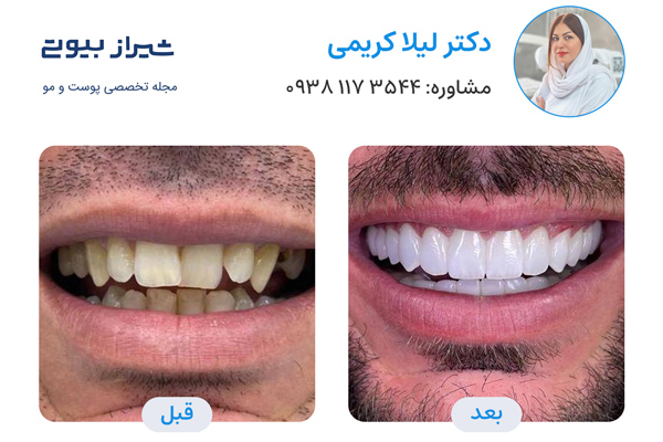 کامپوزیت دندان در شیراز - دکتر لیلا کریمی