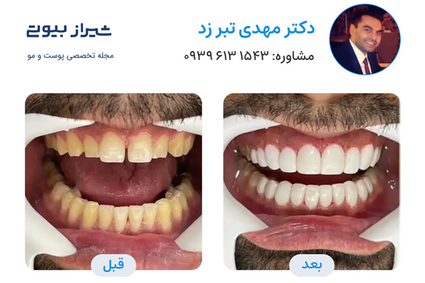 کامپوزیت دندان در شیراز - دکتر مهدی تبر زد