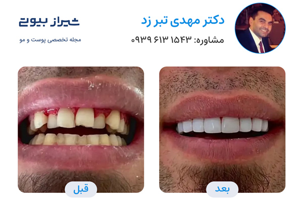 کامپوزیت دندان در شیراز - دکتر مهدی تبر زد