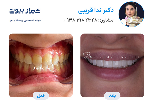 کامپوزیت دندان در شیراز - دکتر ندا قریبی