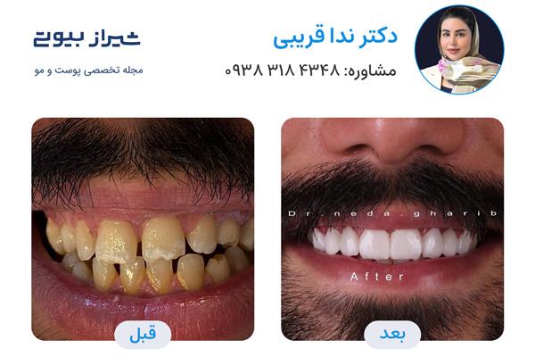 کامپوزیت دندان در شیراز - دکتر ندا قریبی