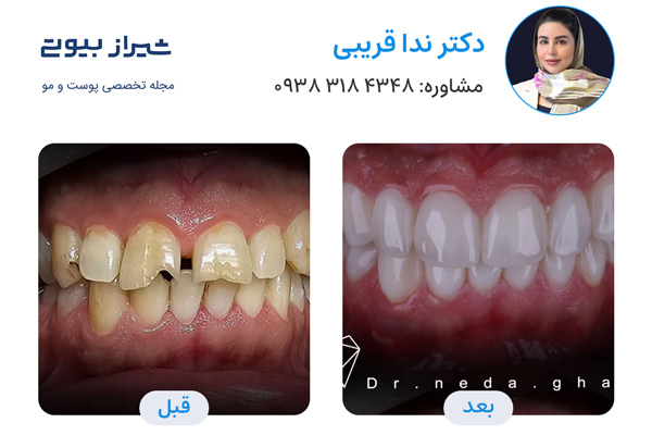 کامپوزیت دندان در شیراز - دکتر ندا قریبی