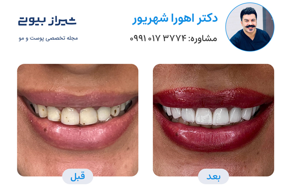 بهترین دکتر کامپوزیت دندان در شیراز، دکتر اهورا شهریور