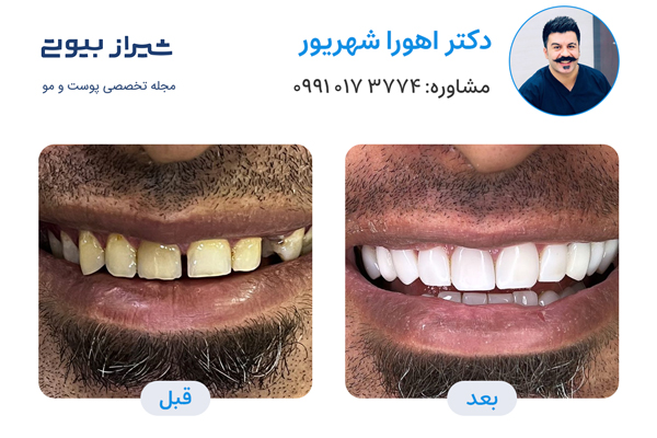 بهترین دکتر کامپوزیت دندان در شیراز، دکتر اهورا شهریور