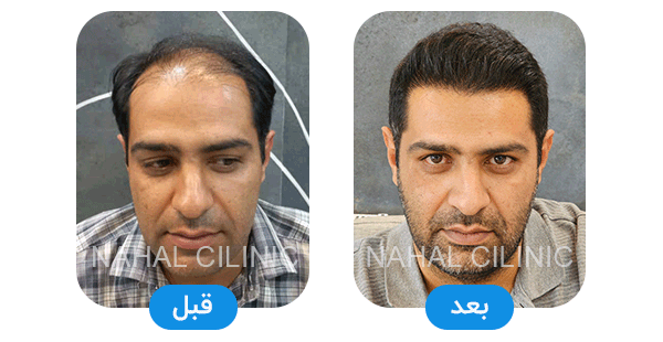 hair transplant shiraz before after A