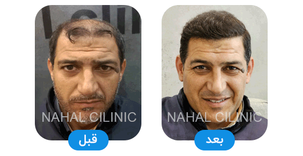 hair transplant shiraz before after B