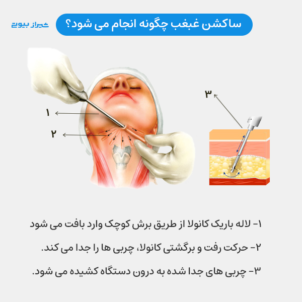 ساکشن غبغب چگونه انجام می شود؟ 