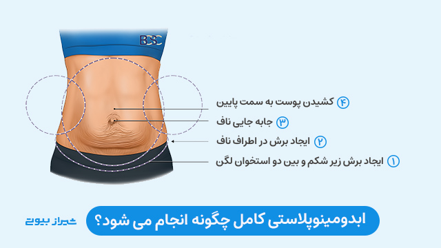 ابدومینوپلاستی کامل چگونه انجام می شود؟ 