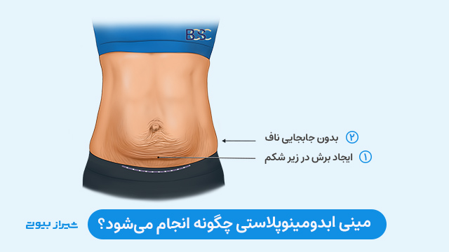 مینی ابدومینوپلاستی چگونه انجام می‌شود؟ 