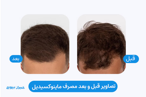 عکس قبل و بعد مصرف ماینوکسیدیل