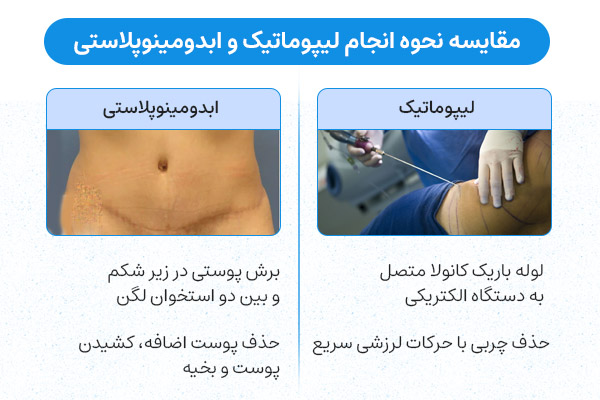 مقایسه نحوه انجام لیپوماتیک و ابدومینوپلاستی