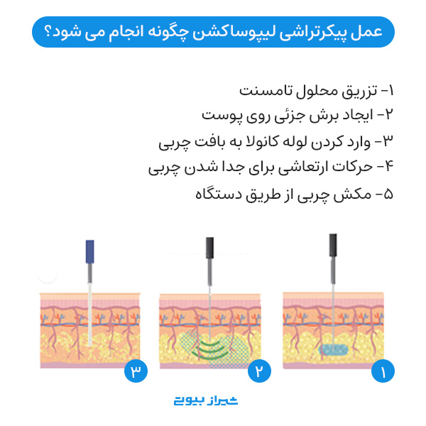 عمل پیکرتراشی لیپوساکشن چگونه انجام می شود؟