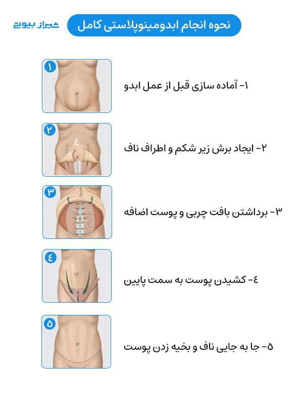 نحوه انجام ابدومینوپلاستی کامل