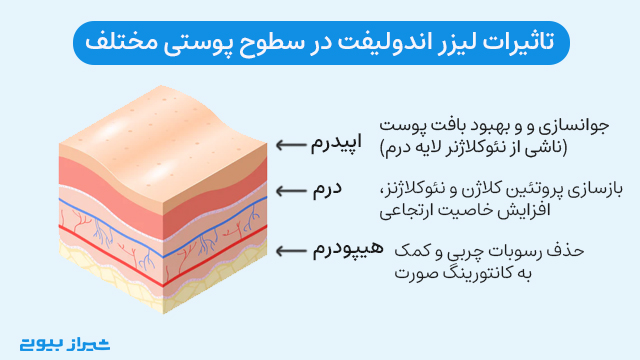 تاثیرات لیزر اندولیفت در سطوح پوستی مختلف