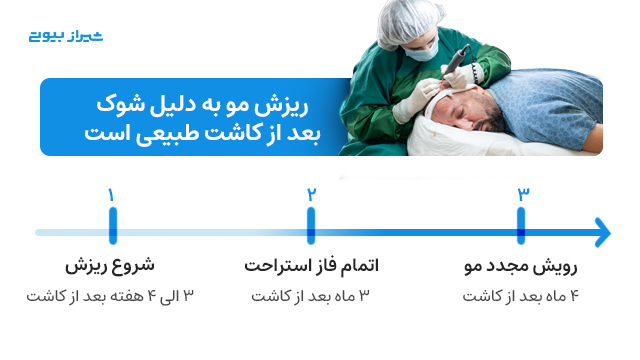 ریزش مو به دلیل شوک بعد از کاشت طبیعی است