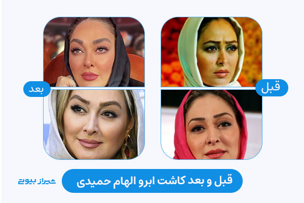 قبل و بعد کاشت ابرو الهام حمیدی