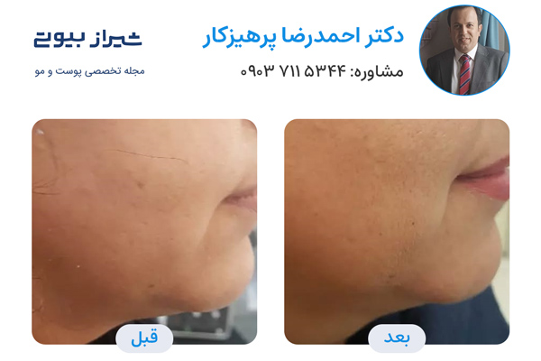 لیزر فرکس پرو در شیراز - دکتر احمدرضا پرهیزکار