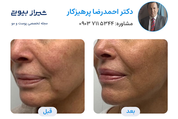 لیزر فرکس پرو در شیراز - دکتر احمدرضا پرهیزکار