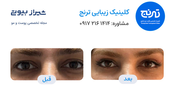 بلفاروپلاستی در شیراز - کلینیک ترنج