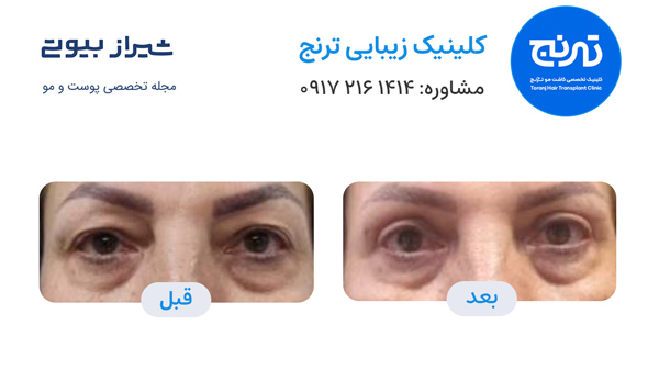 بلفاروپلاستی در شیراز - کلینیک ترنج