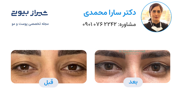 بلفاروپلاستی در شیراز - دکتر سارا محمدی