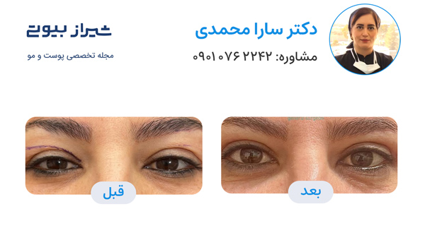 بلفاروپلاستی در شیراز - دکتر سارا محمدی