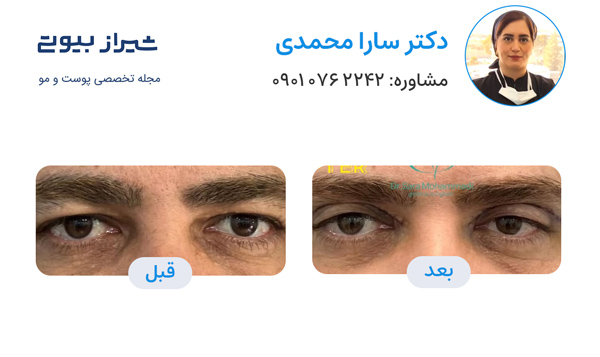 بلفاروپلاستی در شیراز - دکتر سارا محمدی