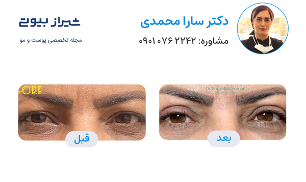 بلفاروپلاستی در شیراز - دکتر سارا محمدی