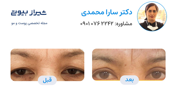 بلفاروپلاستی در شیراز - دکتر سارا محمدی