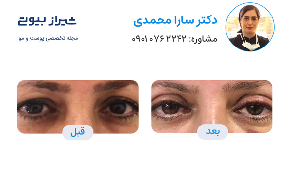 بلفاروپلاستی در شیراز - دکتر سارا محمدی