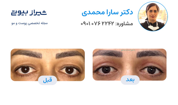 بلفاروپلاستی در شیراز - دکتر سارا محمدی