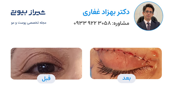 بلفاروپلاستی در شیراز - دکتر بهزاد غفاری
