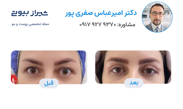 بلفاروپلاستی در شیراز - دکتر امیرعباس صفری پور