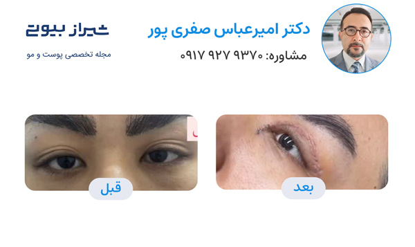 بلفاروپلاستی در شیراز - دکتر امیرعباس صفری پور