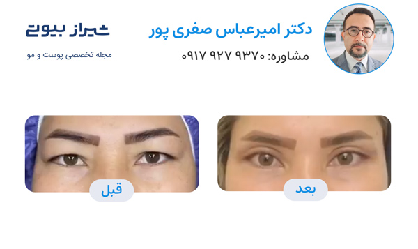 بلفاروپلاستی در شیراز - دکتر امیرعباس صفری پور