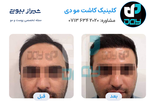 کاشت مو در شیراز - کلینیک دی