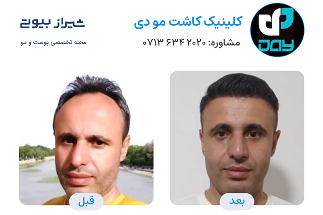 کاشت مو در شیراز - کلینیک دی