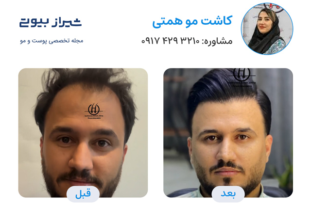 کاشت مو در شیراز - کاشت همتی